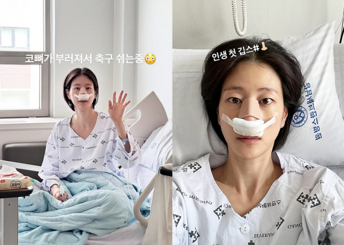 모델 겸 방송인 이현이가 16일 자신의 인스타그램에 축구 경기 중 코뼈가 골절됐다고 밝혔다. 사진은 이현이가 코에 깁스를 하고 있는 모습. /사진=이현이 인스타그램 캡처