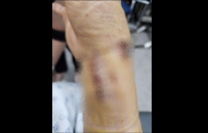 청각장애인인 여성이 행인에게 심한 폭행을 당했으나 경찰의 미흡한 수사로 피해자 가족이 고통을 받고 있다는 사연이 공개됐다. 사진은 지난 20일 온라인커뮤니티를 통해 공개된 폭행 피해자 사진. /사진=온라인커뮤니티 캡처