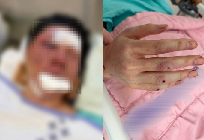 인천 송도국제도시 한 아파트 지하주차장에서 폭행을 당한 100만 유튜버 '수탉'(본명 고진호·31)이 방송 복귀를 예고했다. /사진=숲 라이브 방송캡처